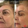 پاکسازی صورت همراه با رونین جوانسازی 